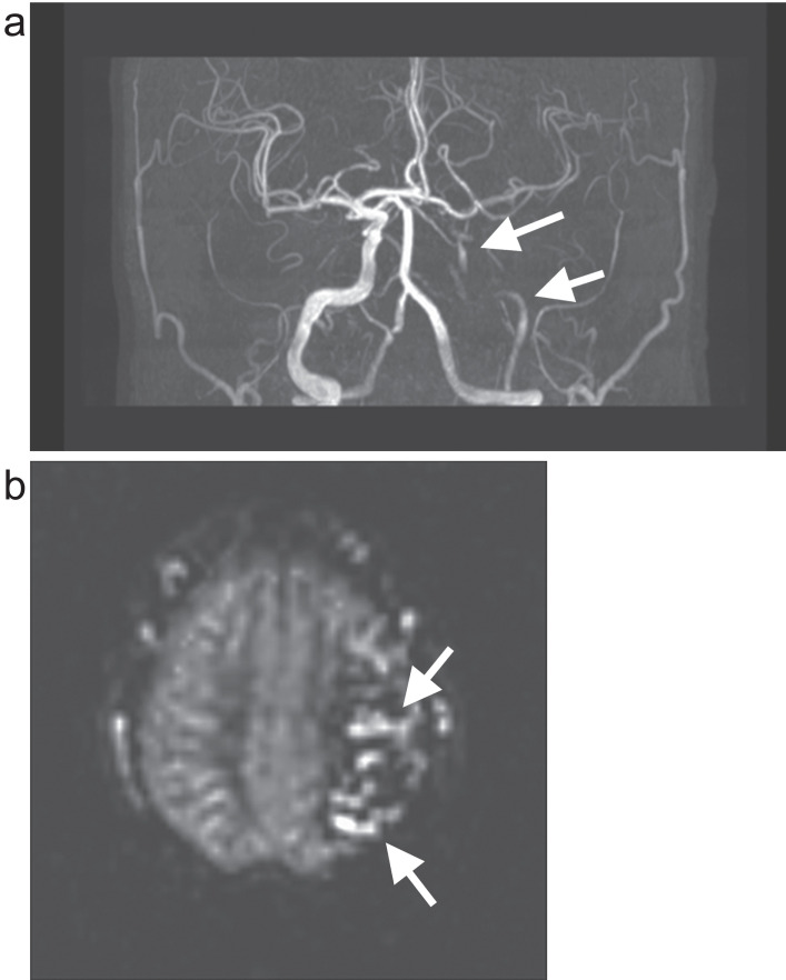 Arterial Spin Labeling for Pediatric Central Nervous System Diseases: Techniques and Clinical Applications.