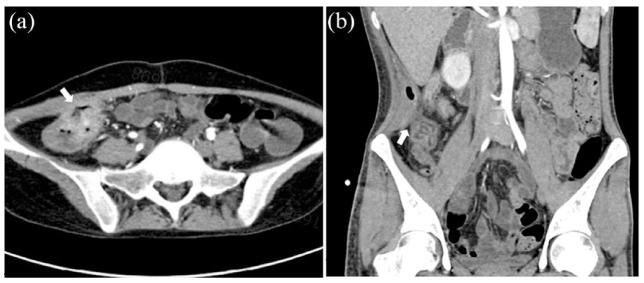 The treatment principles and targets for intestinal Behcet's disease.