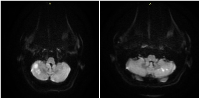 Vertebral Artery Dissection: A Case Report and Review of the Literature.