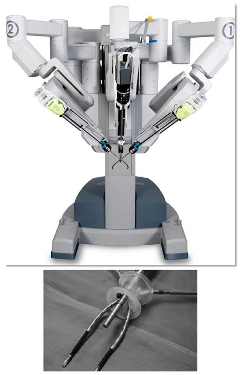 Single-port robotic partial nephrectomy: impact on perioperative outcomes and hospital stay.