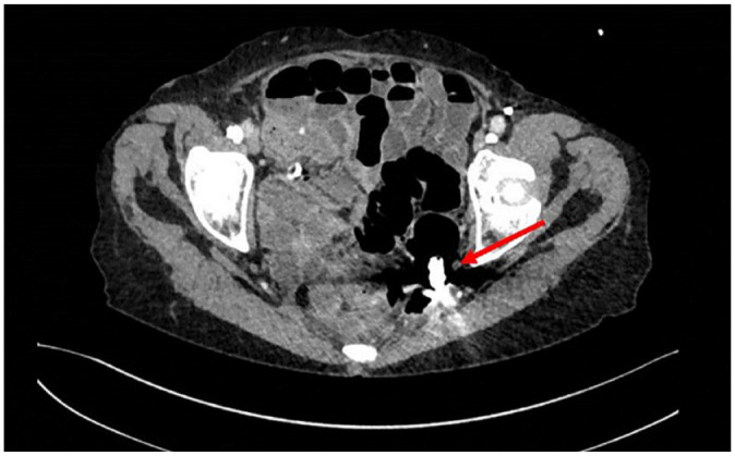 Colon capsule retention in a patient with large bowel stenosis due to diverticulosis - a case report.