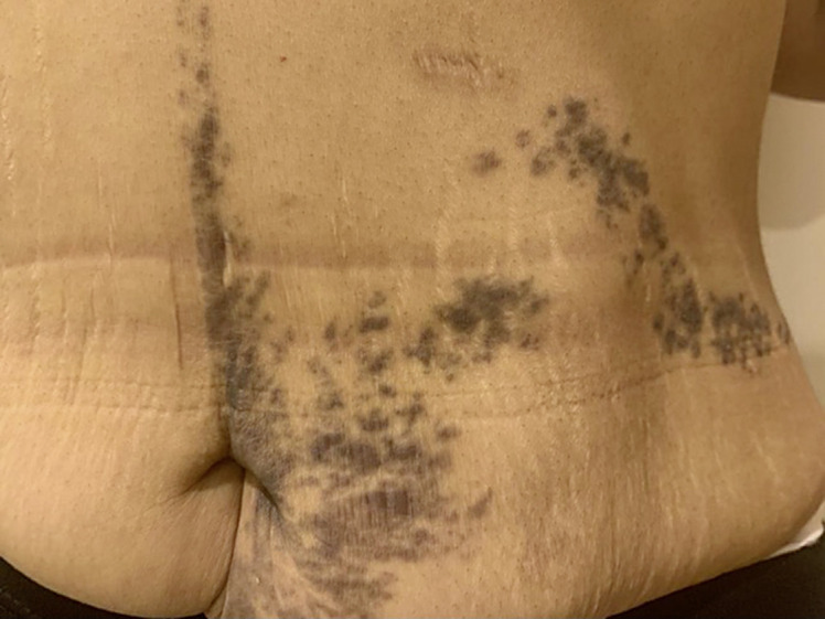 Unilateral Lichen Planus Pigmentosus with Blaschko's Line Distribution: A Case Report.