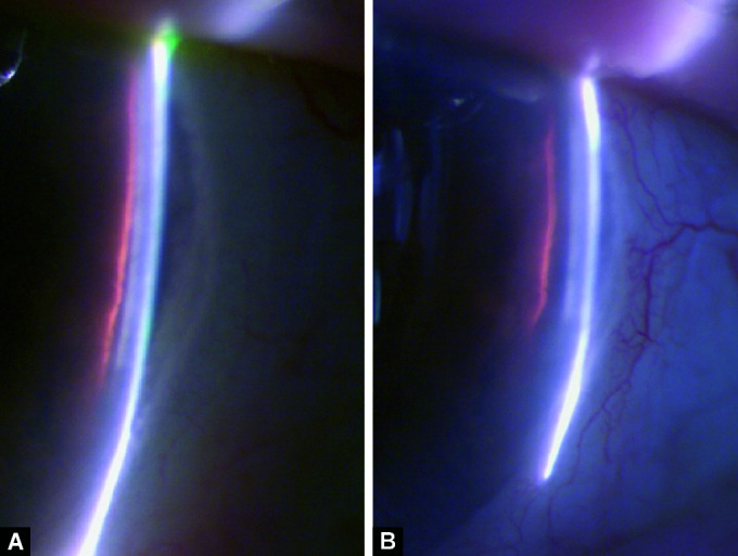 Late-onset Relapse of Aqueous Misdirection after Pars Plana Vitrectomy: Case Report and Literature Review.