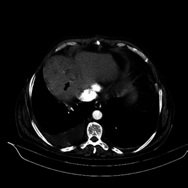 Isolated Intracardiac Metastasis: The First Sign of Hepatocellular Carcinoma.