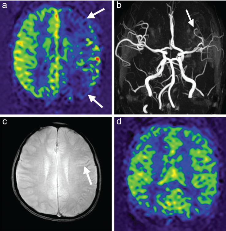 Arterial Spin Labeling for Pediatric Central Nervous System Diseases: Techniques and Clinical Applications.