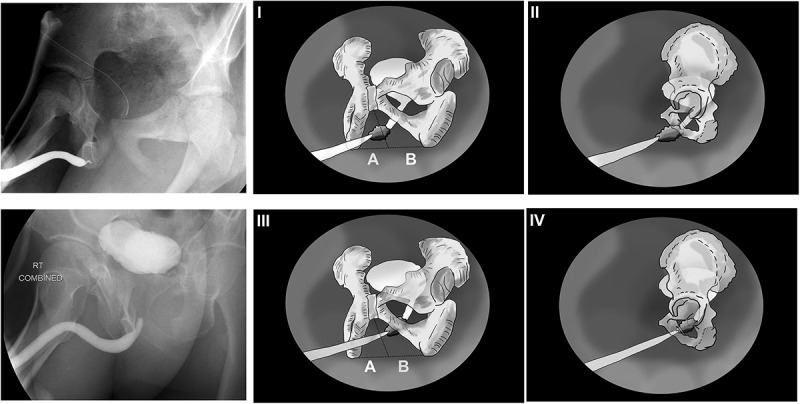 Could the bulbar urethral end location on the cystourethrogram predict the outcome after posterior urethroplasty for pelvic fracture urethral injury?