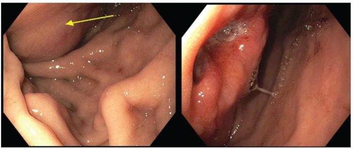 Non-islet cell tumor hypoglycemia associated with Gastrointestinal Stromal Tumor: Case report and review of the literature.