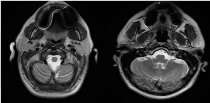 Vertebral Artery Dissection: A Case Report and Review of the Literature.