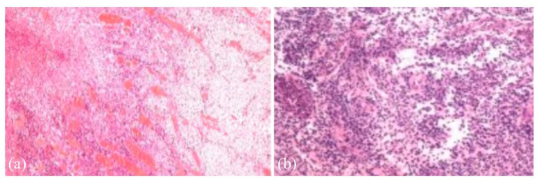 The treatment principles and targets for intestinal Behcet's disease.