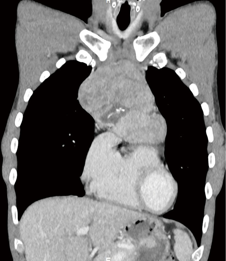 Good's syndrome and COVID-19: case report and literature review.