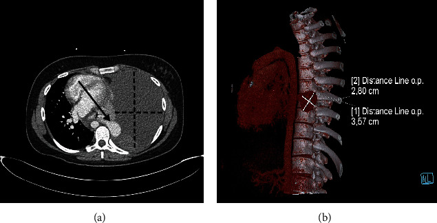 Pulmonary Arteriovenous Malformation Unmasked by Pregnancy: A Review of Pulmonary Arteriovenous Malformations and Cardiovascular and Respiratory Changes in Pregnancy.