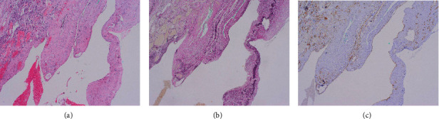 Pulmonary Arteriovenous Malformation Unmasked by Pregnancy: A Review of Pulmonary Arteriovenous Malformations and Cardiovascular and Respiratory Changes in Pregnancy.