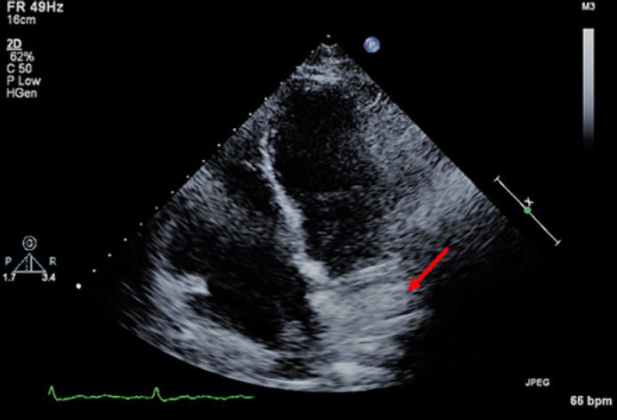 Isolated Intracardiac Metastasis: The First Sign of Hepatocellular Carcinoma.