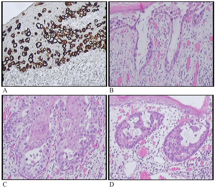 Mammary Paget's Disease of Young Females: Case Reports and Comparison With Middle-Aged and Elderly Patients.