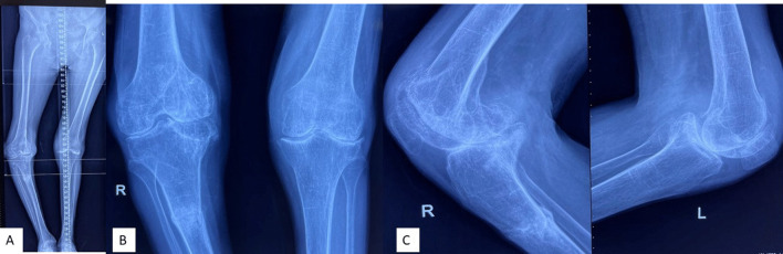 Single-stage long-stem total knee arthroplasty in severe arthritis with stress fracture: a systematic review.