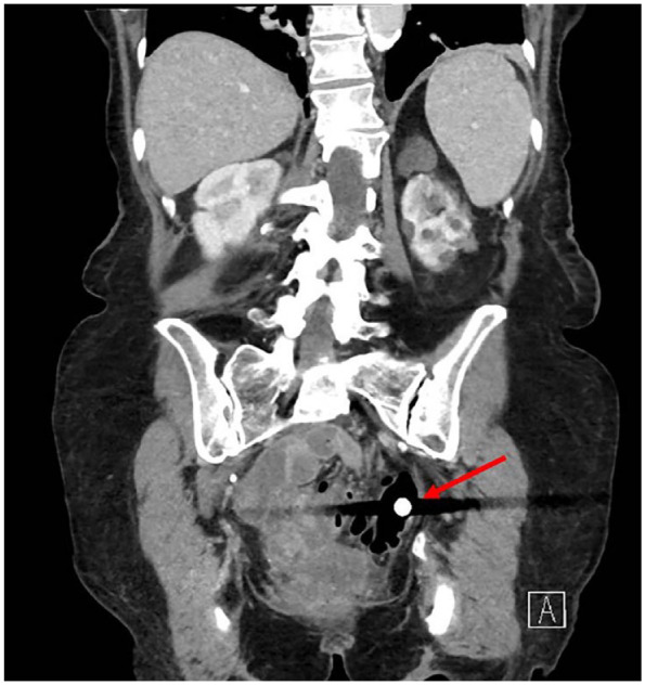 Colon capsule retention in a patient with large bowel stenosis due to diverticulosis - a case report.