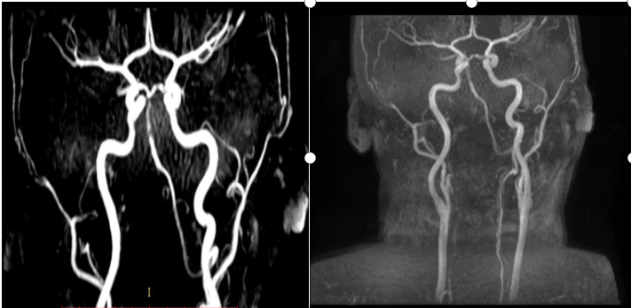 Vertebral Artery Dissection: A Case Report and Review of the Literature.