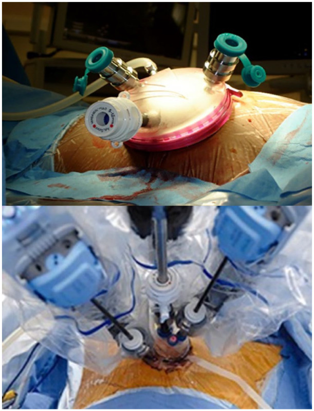 Single-port robotic partial nephrectomy: impact on perioperative outcomes and hospital stay.