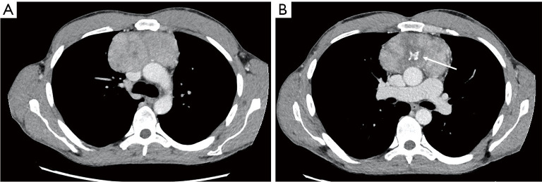 Good's syndrome and COVID-19: case report and literature review.