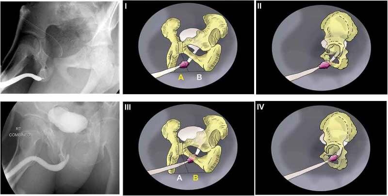 Could the bulbar urethral end location on the cystourethrogram predict the outcome after posterior urethroplasty for pelvic fracture urethral injury?