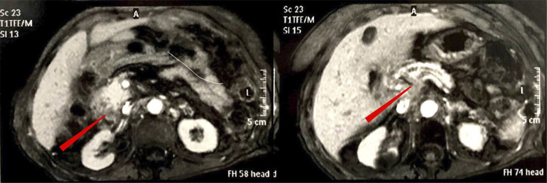 Pancreatic tuberculosis in a liver transplant recipient: a case report.