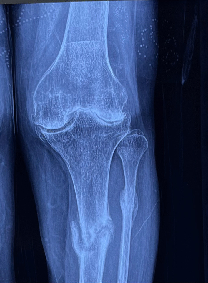 Single-stage long-stem total knee arthroplasty in severe arthritis with stress fracture: a systematic review.