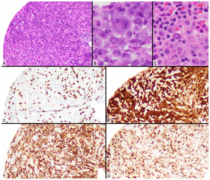 ALK-positive anaplastic large cell lymphoma in adults.