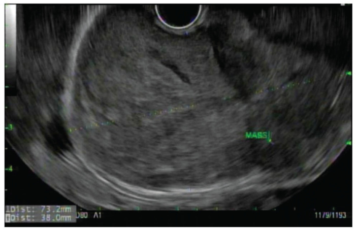 Non-islet cell tumor hypoglycemia associated with Gastrointestinal Stromal Tumor: Case report and review of the literature.