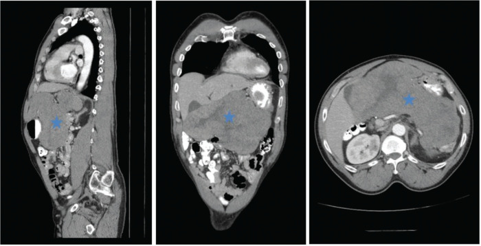 Non-islet cell tumor hypoglycemia associated with Gastrointestinal Stromal Tumor: Case report and review of the literature.