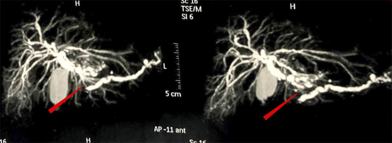 Pancreatic tuberculosis in a liver transplant recipient: a case report.