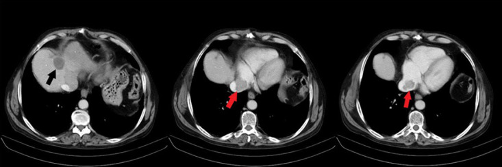 Isolated Intracardiac Metastasis: The First Sign of Hepatocellular Carcinoma.