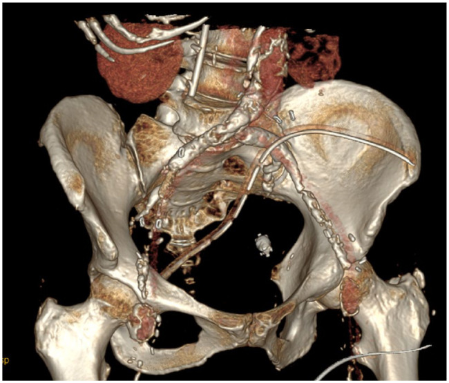 Colon capsule retention in a patient with large bowel stenosis due to diverticulosis - a case report.