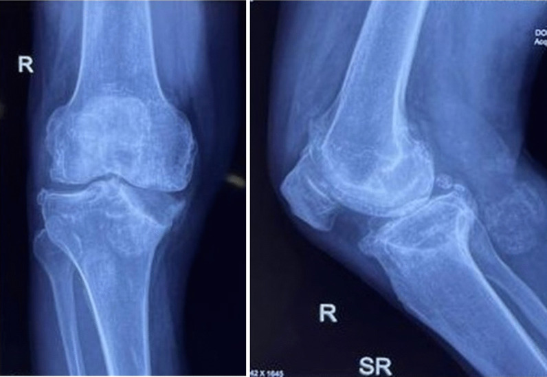 Single-stage long-stem total knee arthroplasty in severe arthritis with stress fracture: a systematic review.