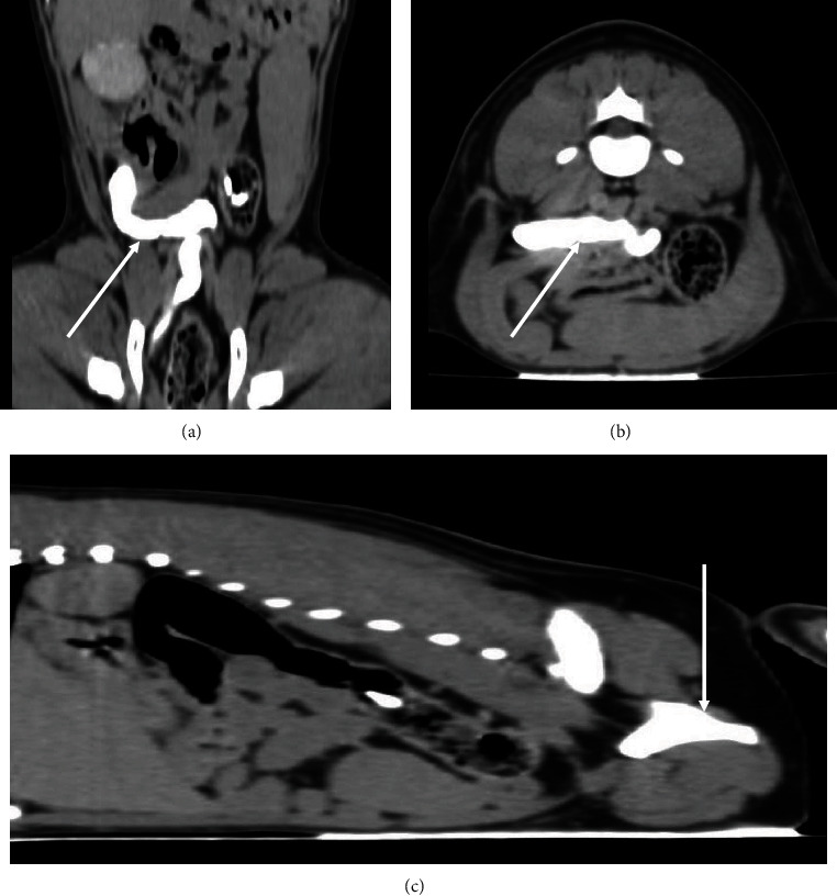 Renal Agenesis, Extramural Ectopic Ureter, and Nonfunctioning Urinary Bladder: A Difficult Clinical Case with an Innovative Approach.