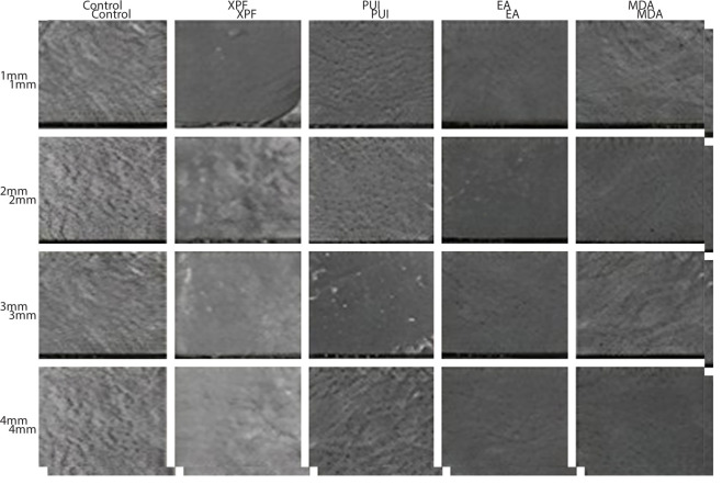 Evaluation of Different Agitation Techniques on Smear Layer Formation and Dentine Erosions- An In Vitro Study.