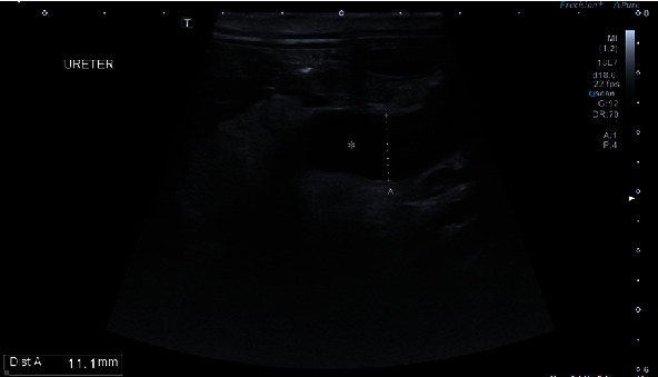 Renal Agenesis, Extramural Ectopic Ureter, and Nonfunctioning Urinary Bladder: A Difficult Clinical Case with an Innovative Approach.