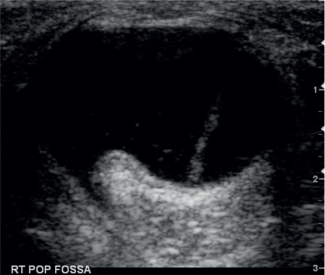 Management of symptomatic Baker's cysts with ultrasound and fluoroscopic-guided aspiration followed by therapeutic injection with Depomedrone and Bupivacaine leads to a durable reduction in pain symptoms in a majority of patients; A case series and literature review.