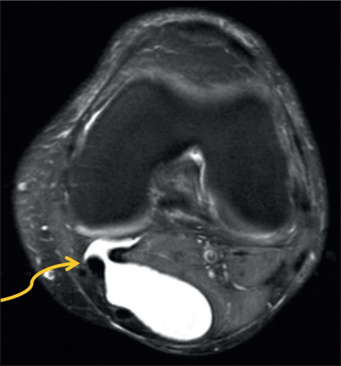 Management of symptomatic Baker's cysts with ultrasound and fluoroscopic-guided aspiration followed by therapeutic injection with Depomedrone and Bupivacaine leads to a durable reduction in pain symptoms in a majority of patients; A case series and literature review.