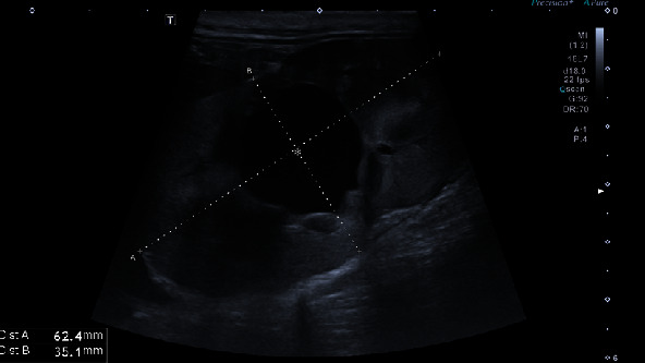 Renal Agenesis, Extramural Ectopic Ureter, and Nonfunctioning Urinary Bladder: A Difficult Clinical Case with an Innovative Approach.