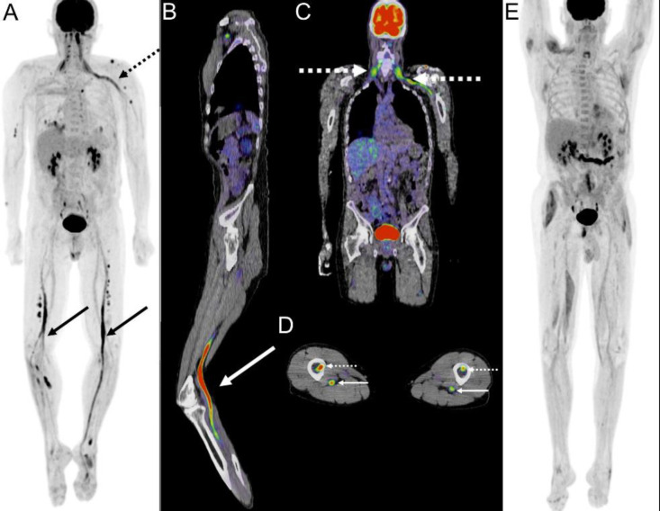 Neurolymphomatosis in Recrudescent Diffuse Large B-cell Lymphoma.