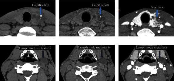 Gemstone Spectral CT Virtual Noncontrast Images and Iodine Maps for the Characterization of Thyroid Lesions and Distinguishing Thyroid Papillary Carcinoma from Nodular Goiter.