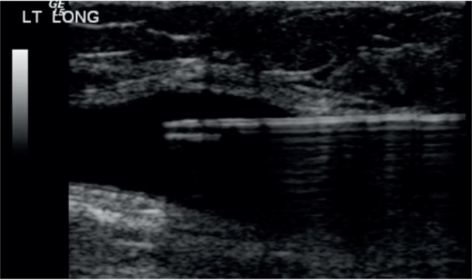 Management of symptomatic Baker's cysts with ultrasound and fluoroscopic-guided aspiration followed by therapeutic injection with Depomedrone and Bupivacaine leads to a durable reduction in pain symptoms in a majority of patients; A case series and literature review.