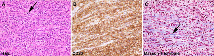 Neurolymphomatosis in Recrudescent Diffuse Large B-cell Lymphoma.