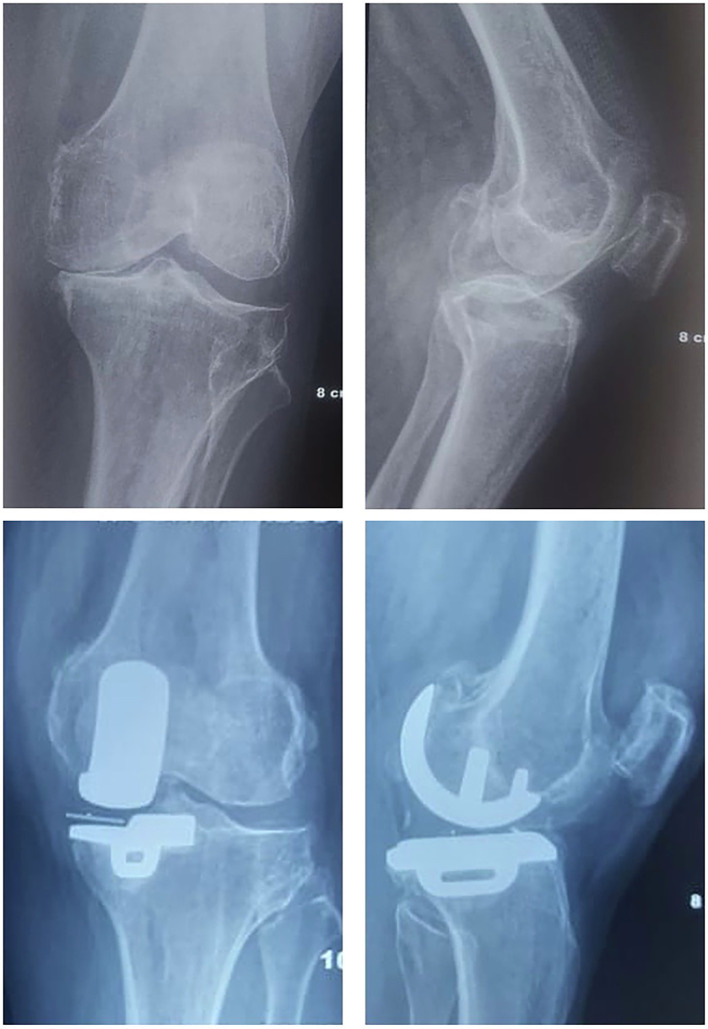 Partial versus total knee arthroplasty for isolated antero-medial osteoarthritis - An analysis of PROMs and satisfaction.