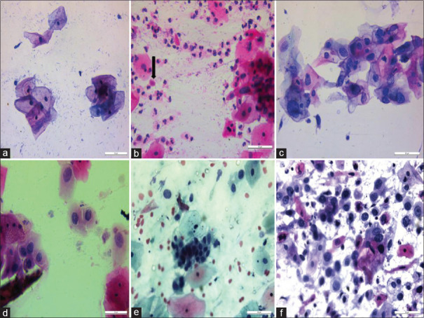 Evaluation of the Cytonucleomorphometric Parameters for Cases Diagnosed as Squamous Cell Abnormality on Conventional Cervico-Vaginal Pap Smears.