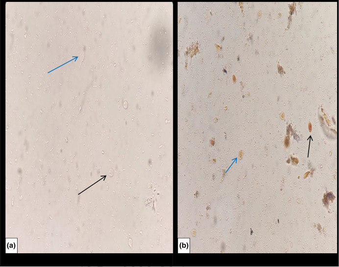 Refractory giardiasis in a child with steroid-resistant nephrotic syndrome.