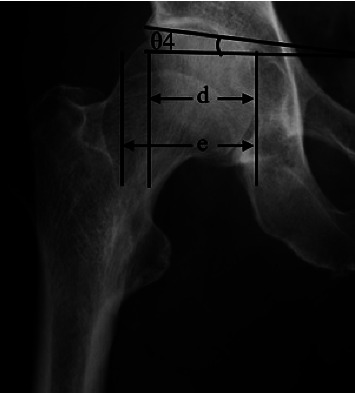 Correlation between Femoral Head Lateralization and Bone Morphology in Primary Hip Osteoarthritis.