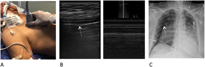 Management of pneumothorax with 8.3-French Pigtail Catheter: description of the ultrasound-guided technique and case series.