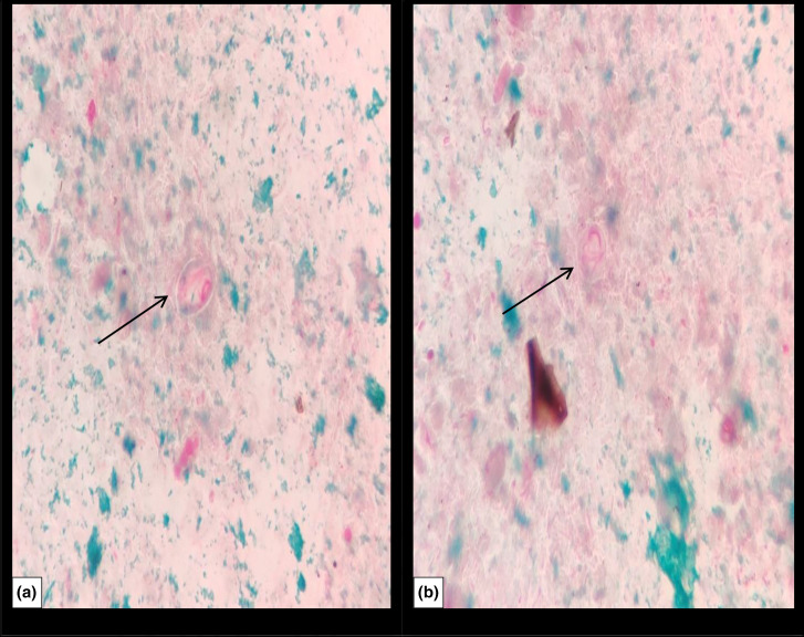 Refractory giardiasis in a child with steroid-resistant nephrotic syndrome.