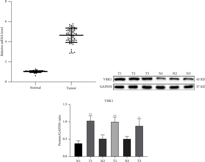 Downregulation of VRK1 Inhibits Progression of Lung Squamous Cell Carcinoma through DNA Damage.